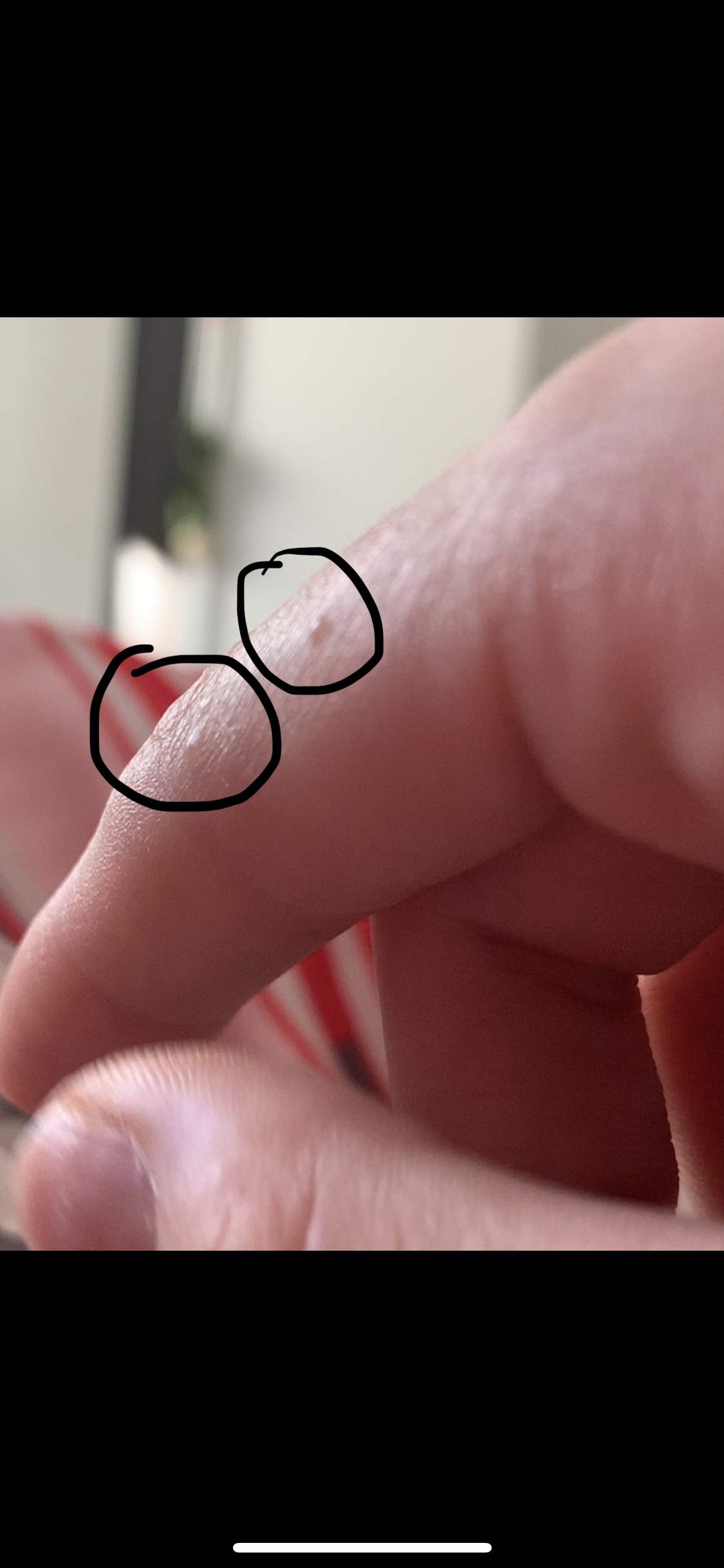 Miniblasen Am Finger Kein Jucken Etc Haut Ausschlag Blasen Miniblasen Am Finger Kein Jucken Etc Haut Ausschlag Blasen