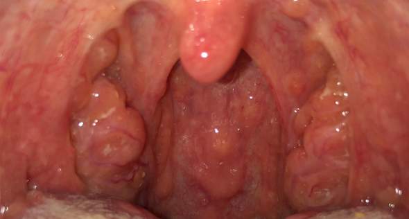 Minimaler Weisser Belag Auf Mandeln Gesundheit Und Medizin Beruf Korper Minimaler Weisser Belag Auf Mandeln Gesundheit Und Medizin Beruf Korper