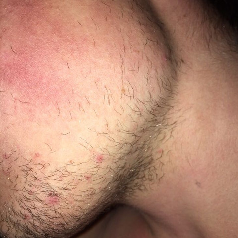 Nach einer Woche wachsen ohne minoxidil  - (Männer, Jugend, Bart)