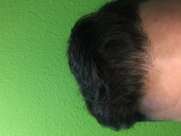ich vorne weniger haare normal