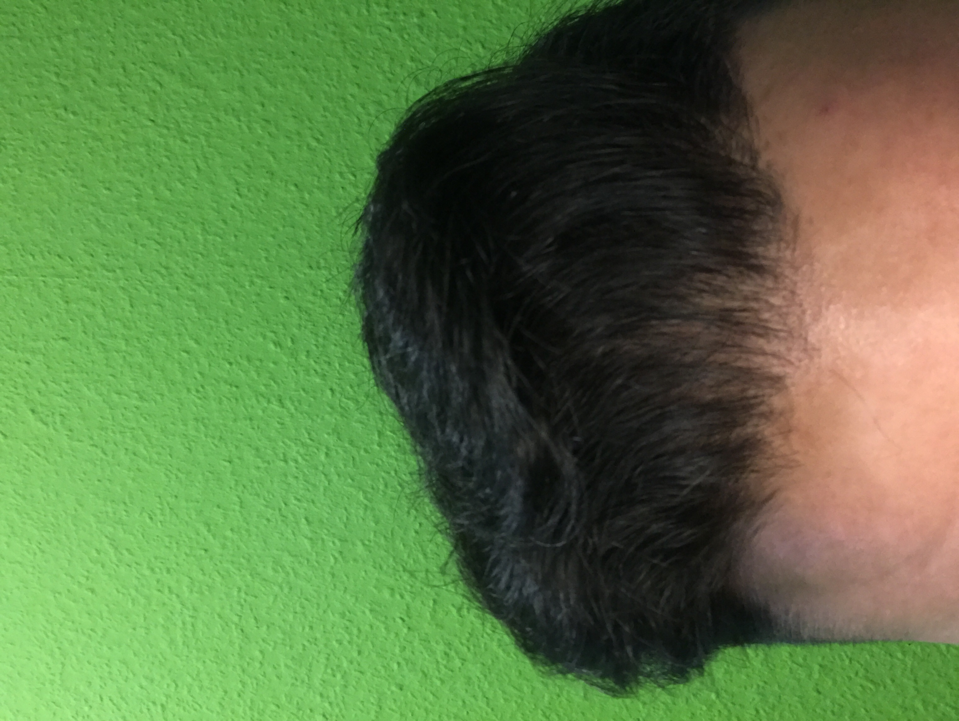 ich vorne weniger haare normal