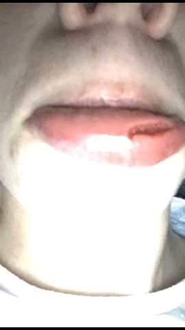 Mist Klaffende Lippe Am ay Was Tun Gesundheit Schmerzen Blut