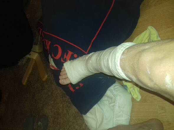 Krücken gipsbein Auf Krücken