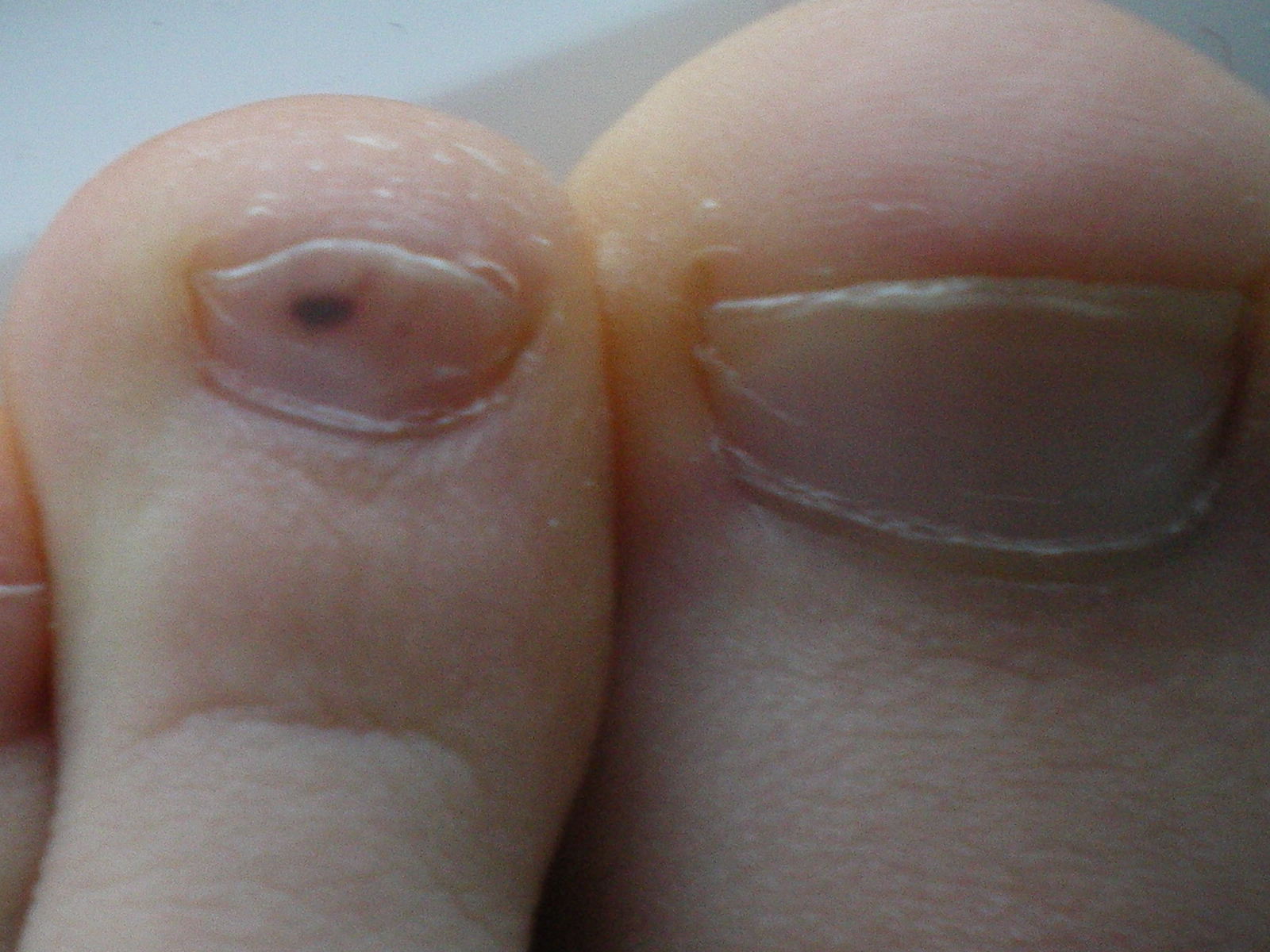 35+ Hautkrebs unterm nagel bilder , Mit 13 Hautkrebs? ( (Gesundheit, Krebs)