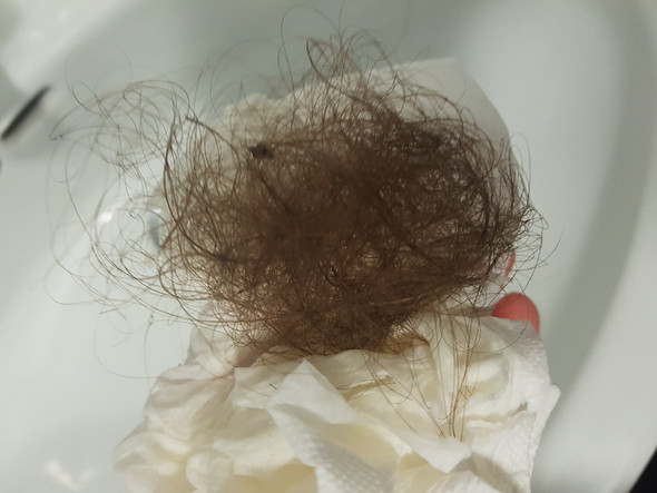 Mit 16 Haarausfall Hilfe Haare Mit 16 Haarausfall Hilfe Haare