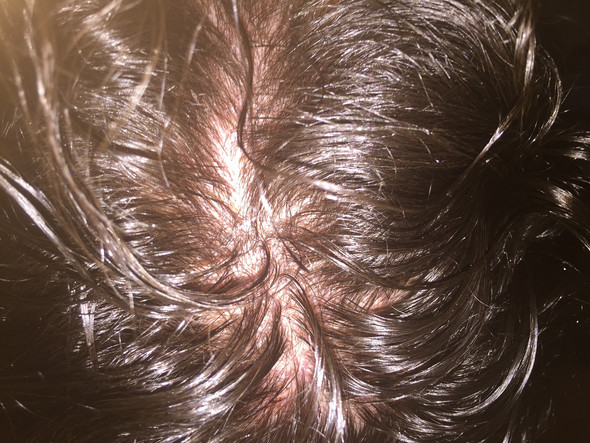 Mit 16 Kahle Stellen Kopfhaut