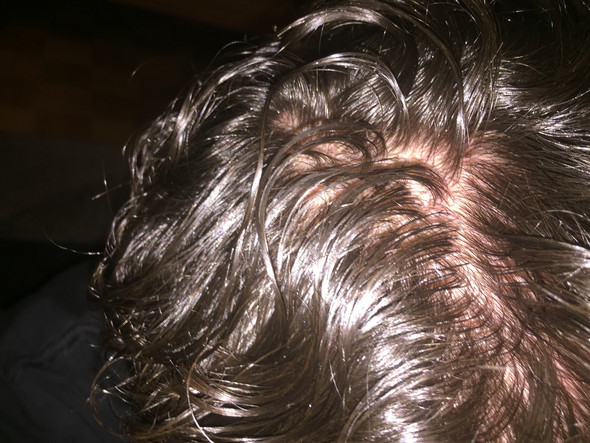 Mit 16 Kahle Stellen Kopfhaut