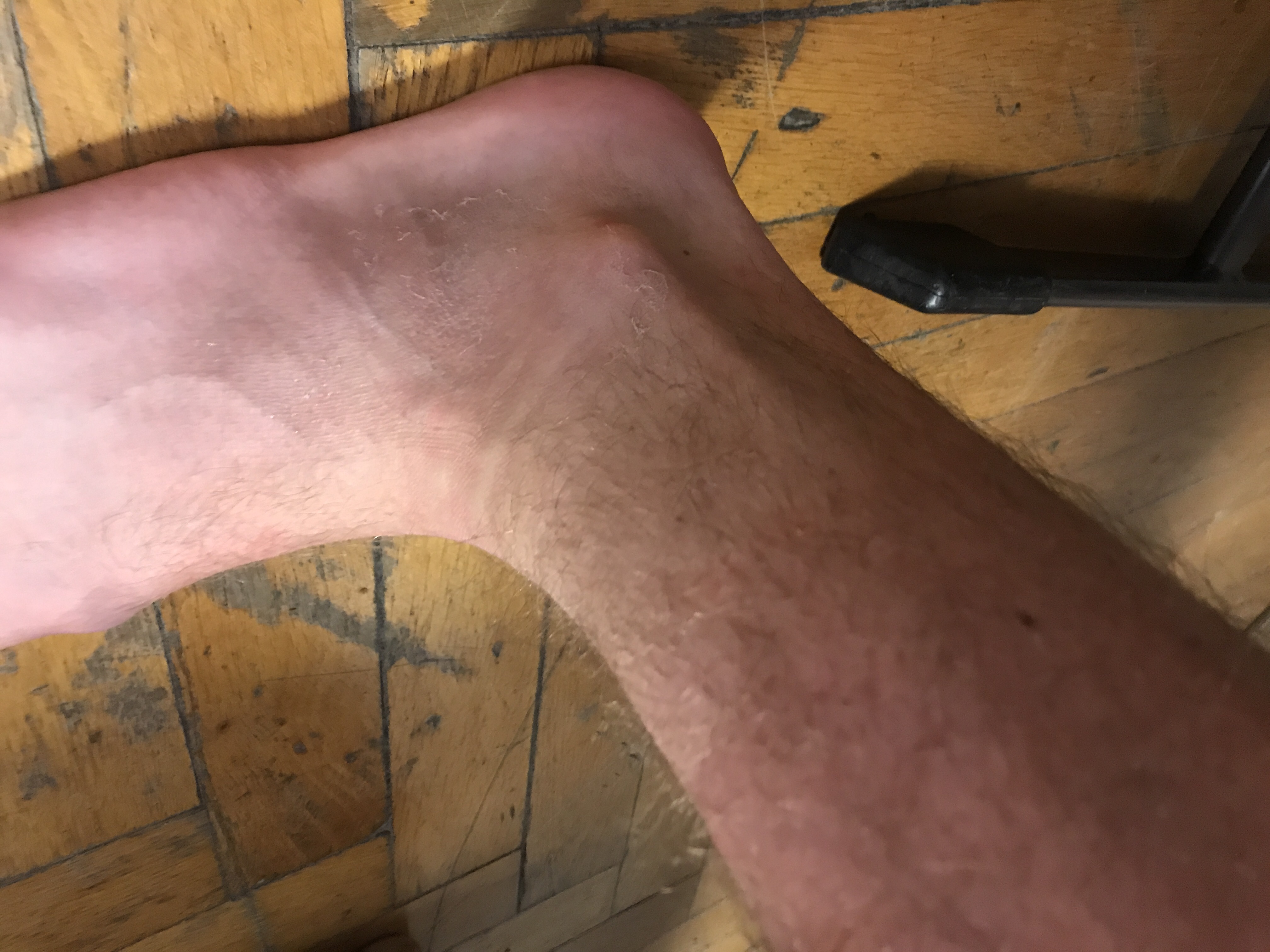 Mit Bänder Überdehnung Ski fahren? (Gesundheit und Medizin, Sport und Fitness, Bänderdehnung)