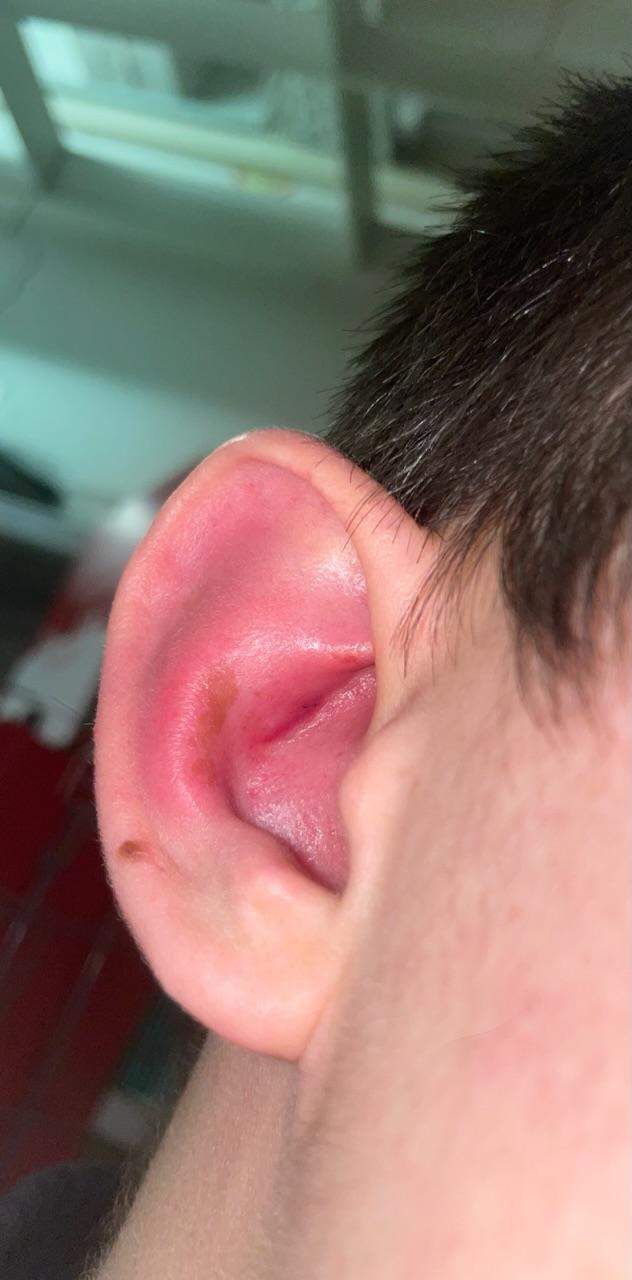 Blumenkohlohr selber machen: Tipps und Tricks von TikTok-Experten Blumenkohlohr selber machen: Tipps und Tricks von TikTok-Experten