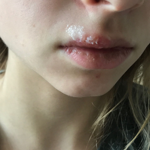 Herpes, Bläschen, Lippenblase - (Gesundheit und Medizin, Arbeit, Lippe)