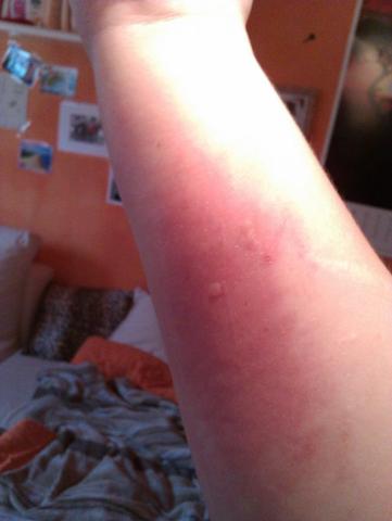 arm - (Wunde, Stich)