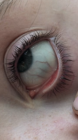 Mit Stift Ins Auge Gestochen Hilfe Gesundheit Und Medizin