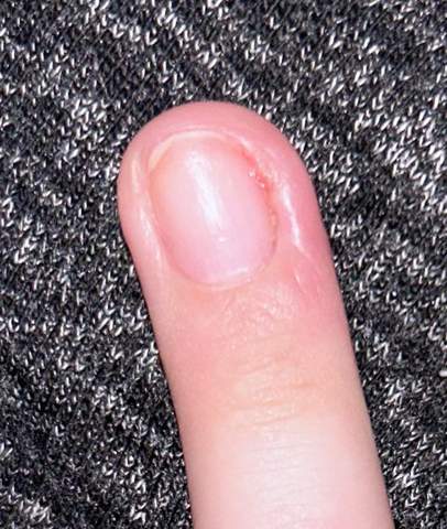 Mit Wunde am Finger ins Nagelstudio?
