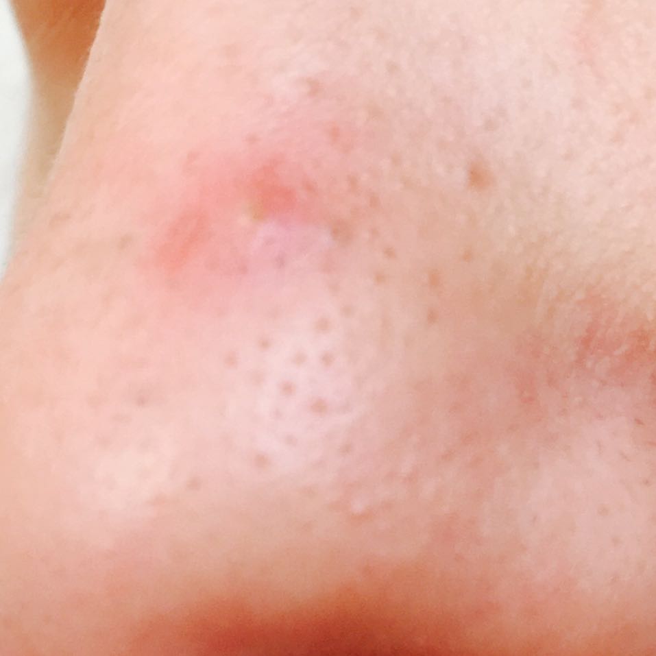 Download Pickel Im Ohr Entfernen Background