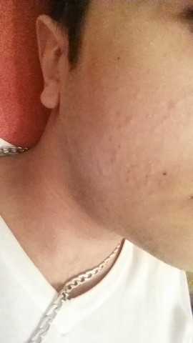 Mitesser Auf Stirn Und Backen Weg Kriegen Pickel