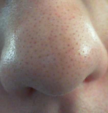 Nase - (Haut, Pickel, Hautpflege)