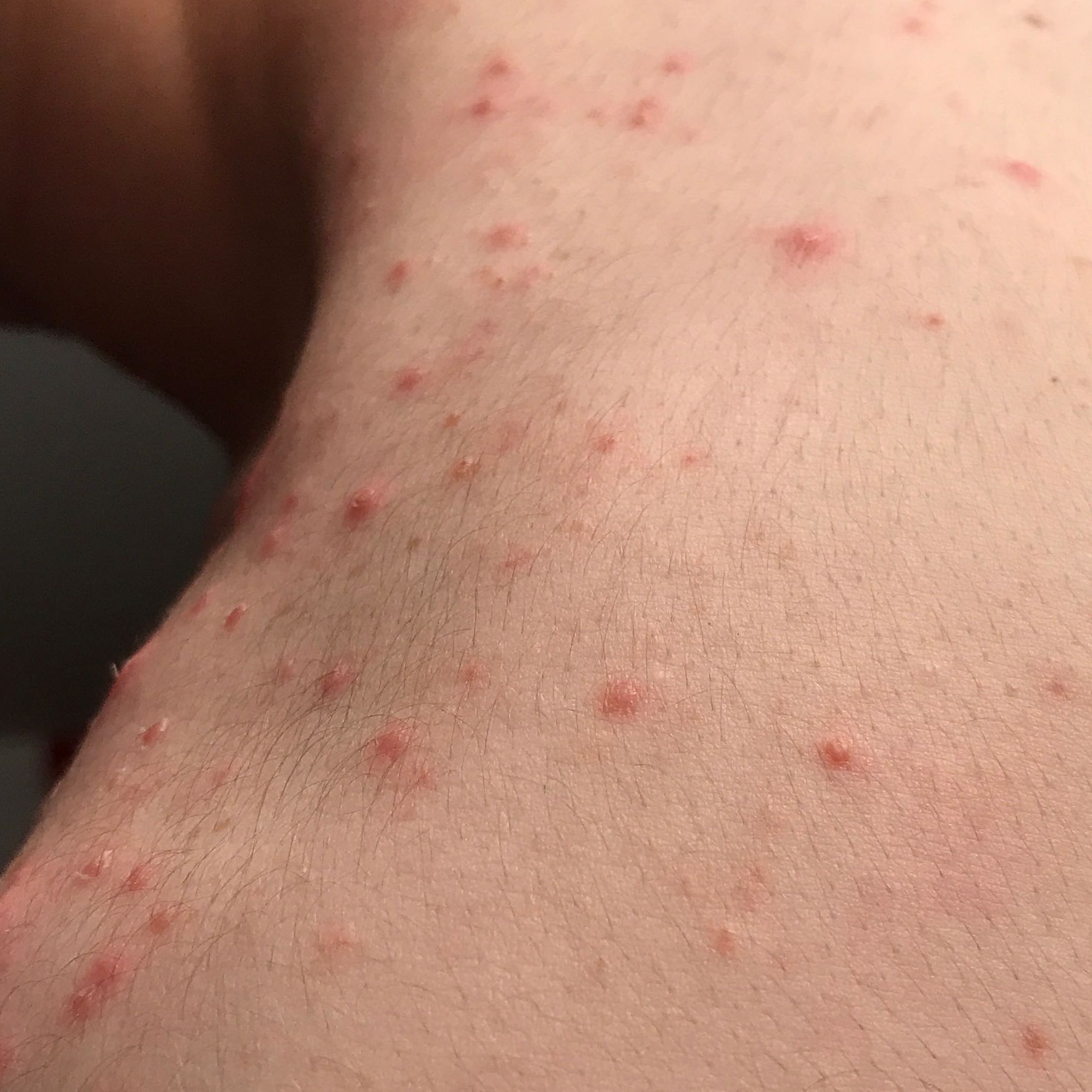 Mitesser/ Pickel/ etwas anderes am Körper? (Haut, Sonnenbrand) pickel auf dem po