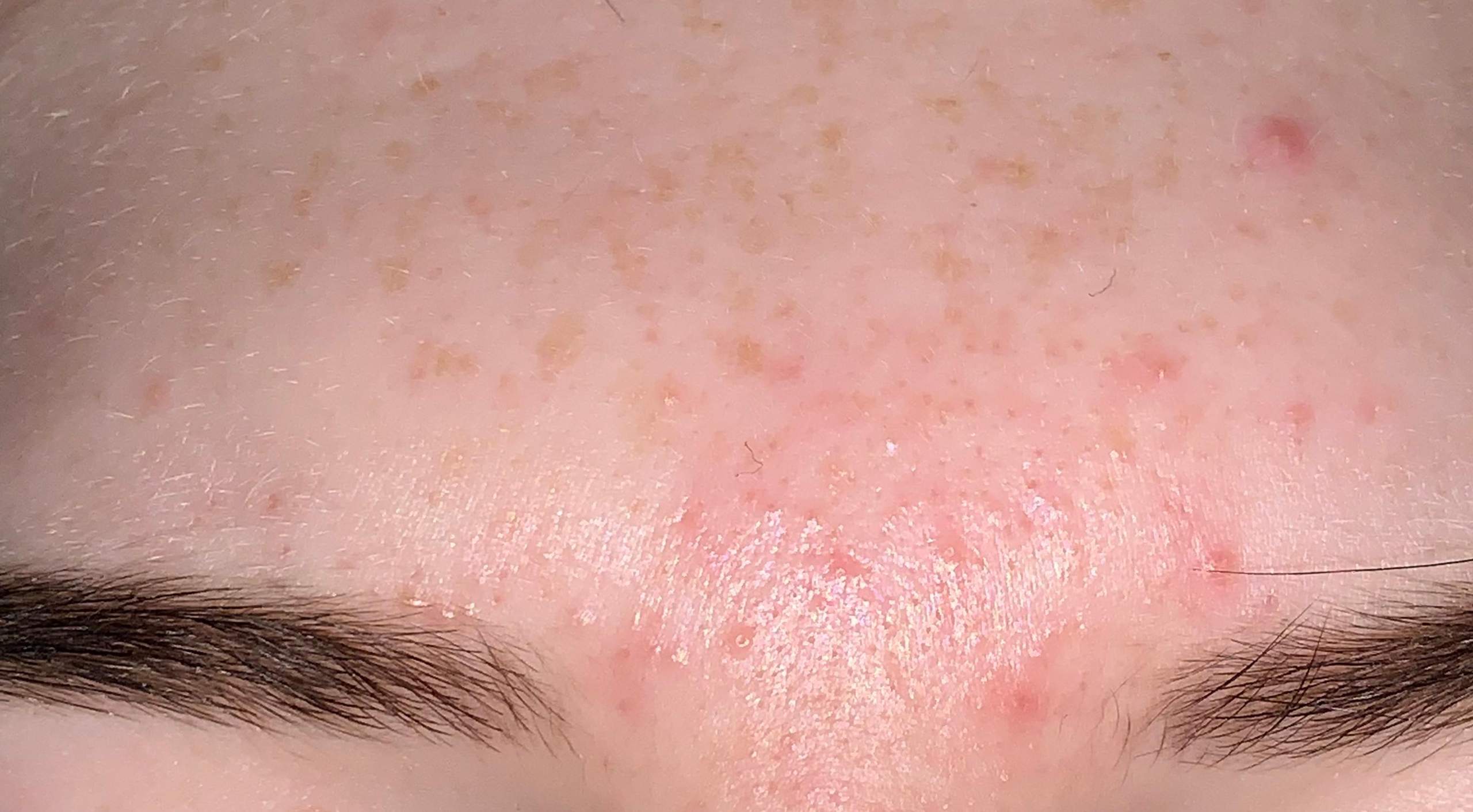 Mitesser und Pickel an der Stirn? (Haut) pickel an stirn