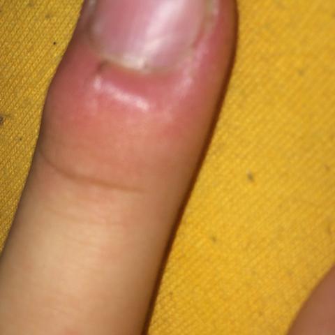 Mein Mittelfinger Ist Angeschwollen Was Kann Das Sein Finger Mein Mittelfinger Ist Angeschwollen Was Kann Das Sein Finger
