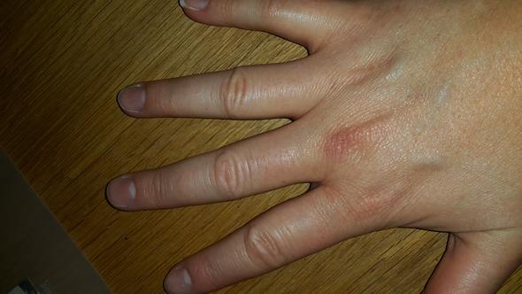 Mittelfinger Grundgelenk Tut Seit Wochen Weh Und Seit Gestern Ist Es Blau Und Etwas Dick Was Kann Das Sein Gesundheit Schmerzen Mittelfinger Grundgelenk Tut Seit Wochen Weh Und Seit Gestern Ist Es Blau Und Etwas Dick Was Kann Das Sein Gesundheit Schmerzen