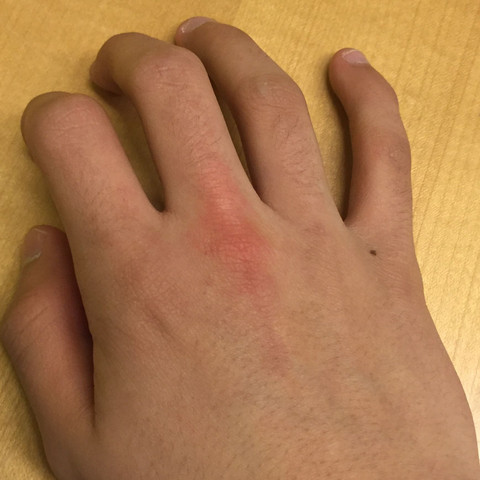 Mittelfinger  - (Körper, Hand, geschwollen)
