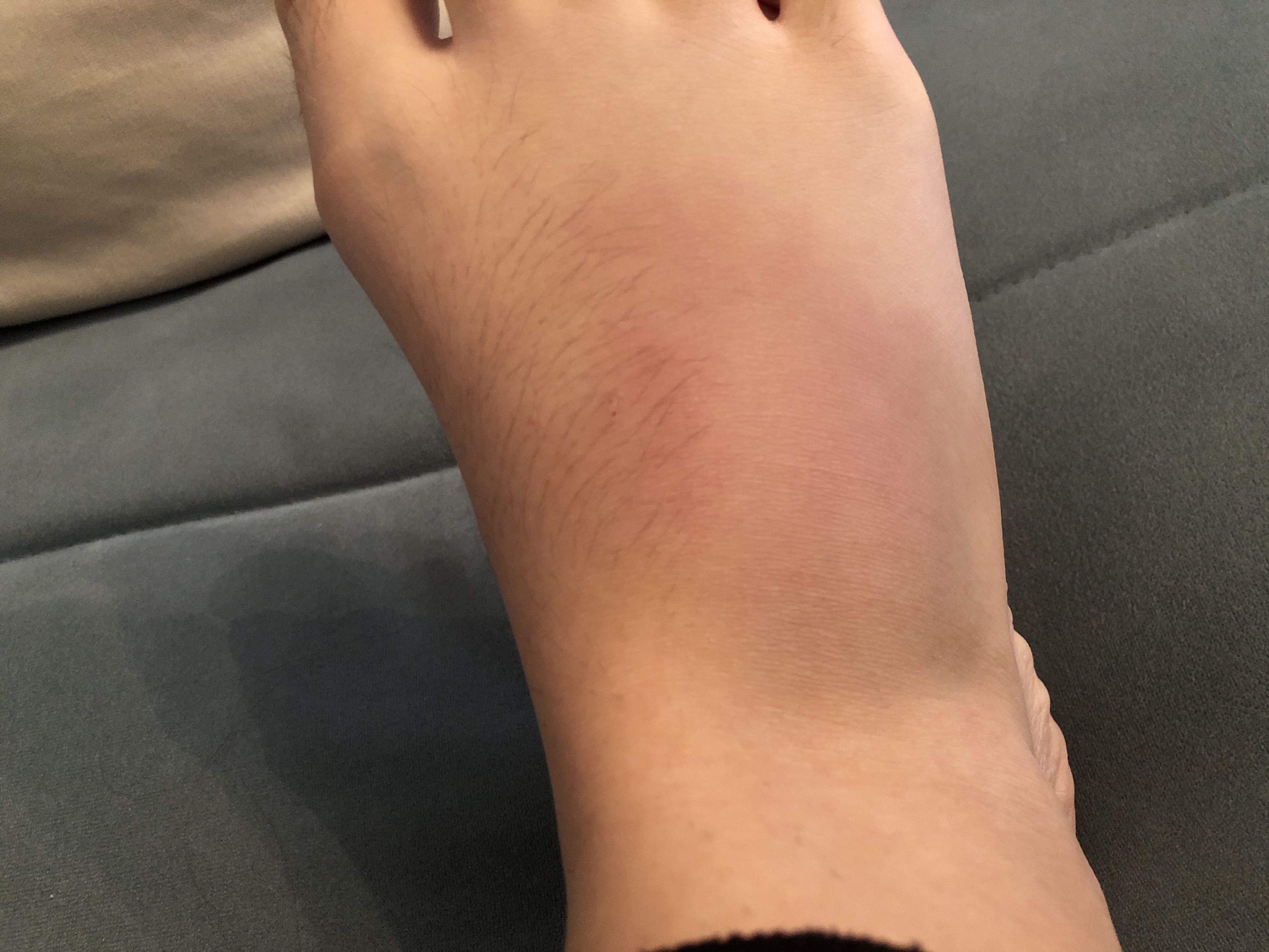 Mittelfussknochen Gebrochen Oder Nicht Gesundheit Und Medizin Gesundheit Fusse