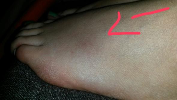 mittelfussknochen… hilfe… dringend (Schmerzen, Mittelfuß)