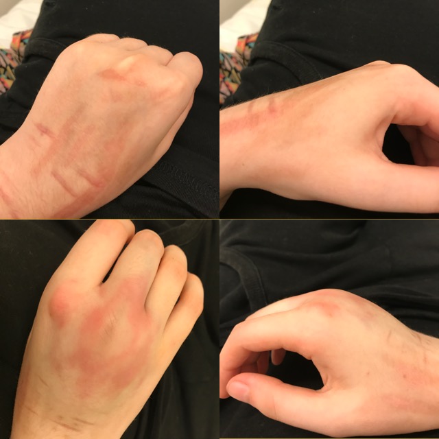 Mittelhandknochen Mittelhandknochen