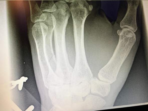 Mittelhandknochenbruch Heilung Ohne Op Hand Fraktur Mittelhandknochenbruch Heilung Ohne Op Hand Fraktur