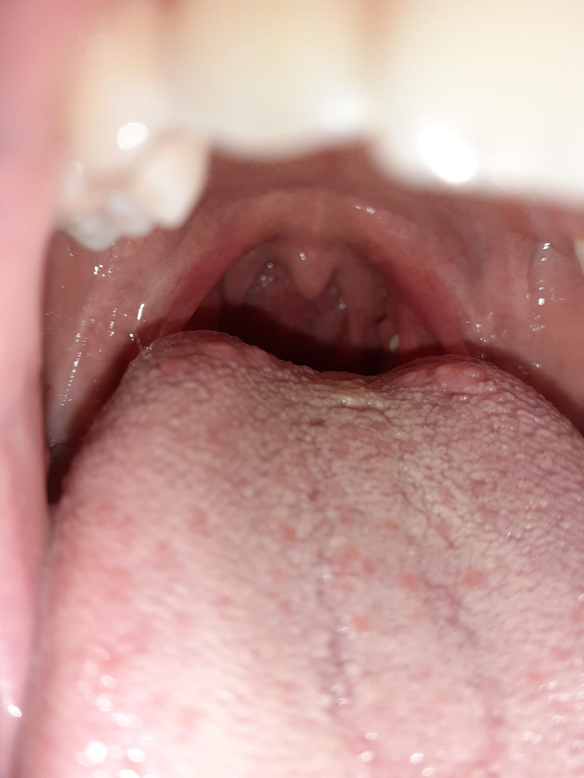 Mandelsteine Entfernen Ohne Wurgen Mandelsteine Entfernen Ohne Wurgen