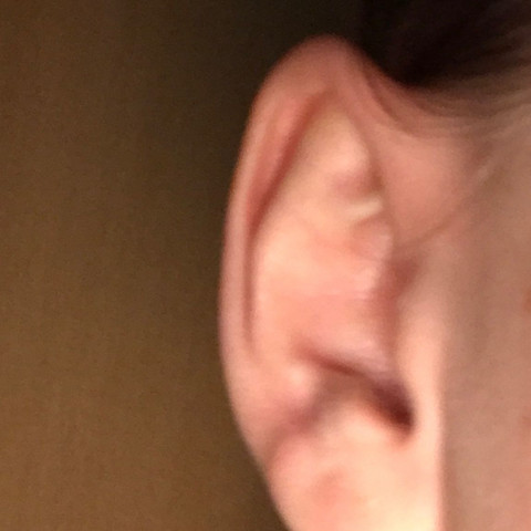 Erfahrungen fadenmethode ohren anlegen Abstehende Ohren