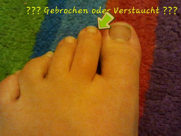 Mochte Wissen Ob Mein Zeh Gebrochen Ist Oder Nur Verstaucht Schmerzen Mochte Wissen Ob Mein Zeh Gebrochen Ist Oder Nur Verstaucht Schmerzen
