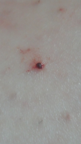 Mogliche Zecke Selbst Mit Gewohnlicher Pinzette Selbst Entfernen Oder Erst Morgen Damit Zum Arzt Angst Bakterien Selbsthilfe