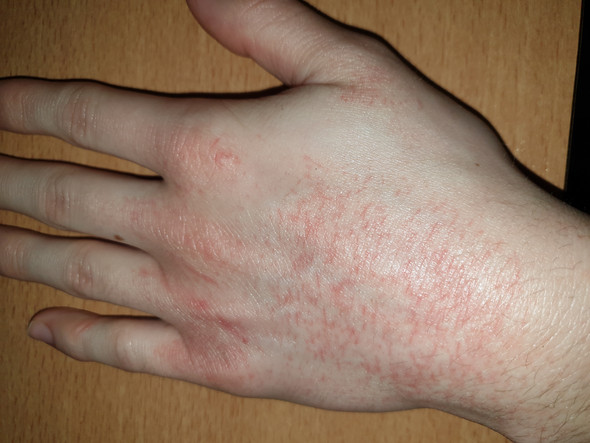 Moglicher Ausschlag Auf Hand Gesundheit Und Medizin Moglicher Ausschlag Auf Hand Gesundheit Und Medizin