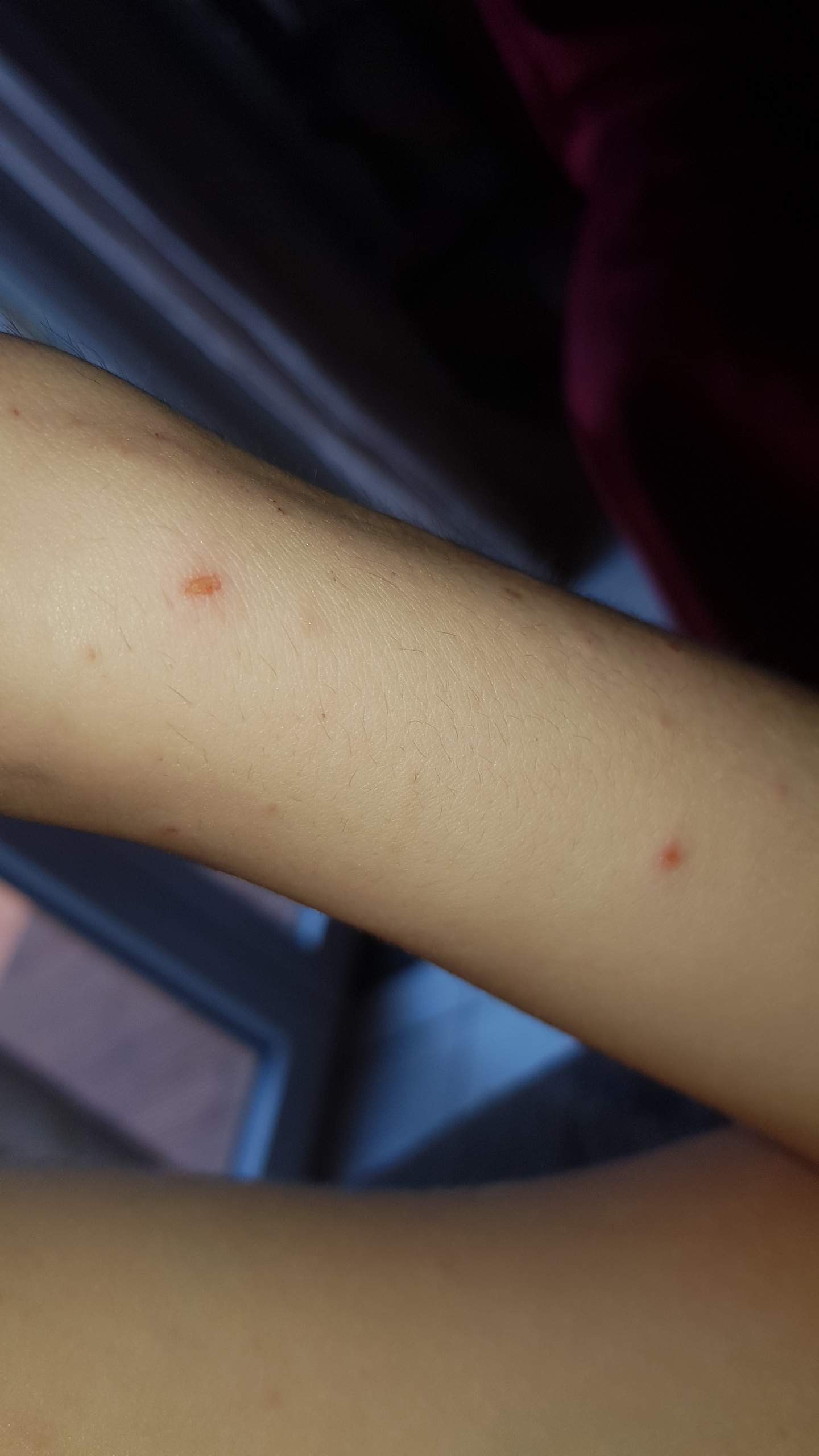 Moin Sieht das aus wie krätze oder eine allergie? Gesundheit und Medizin, Krankheit)