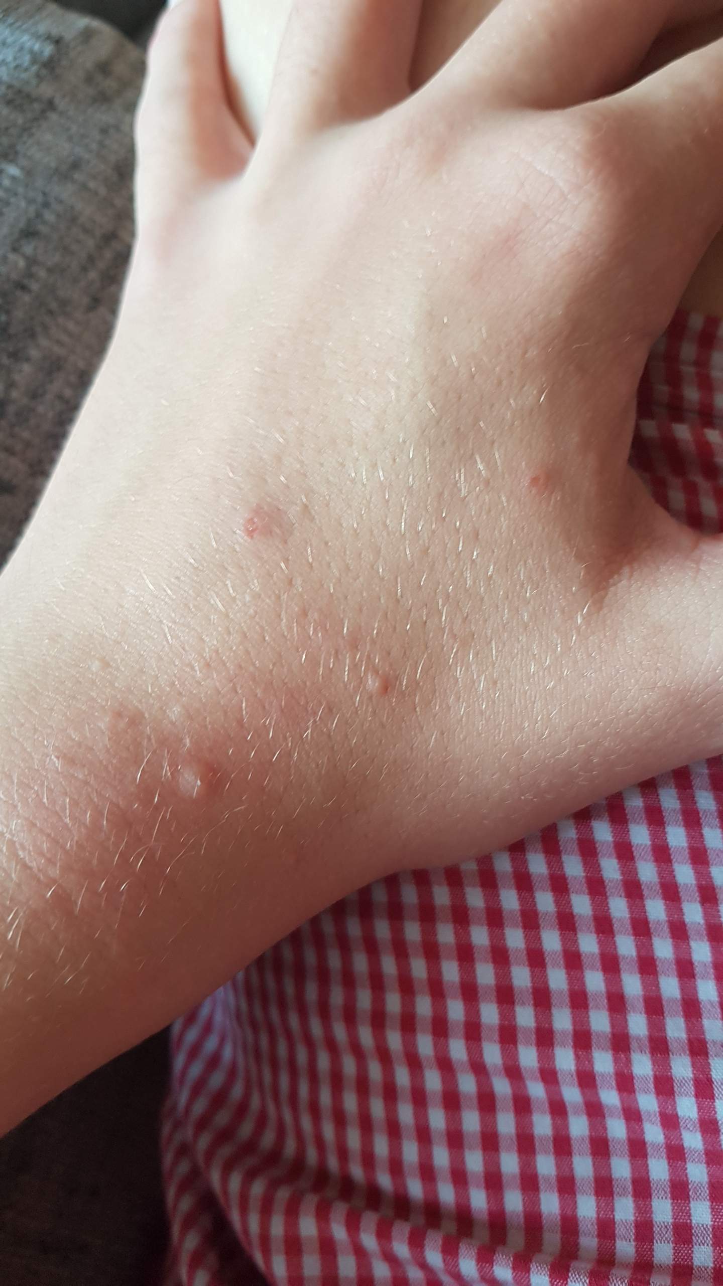 Wie Sieht Eine Analthrombose Aus