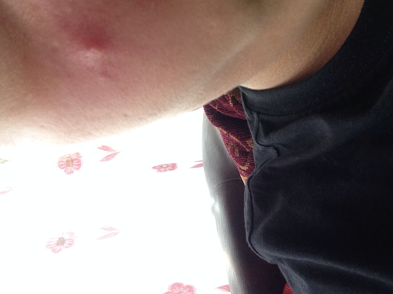 Morgen Klassenfoto und dicker pickel auf der Wange (Haut) pickel in der wange innen