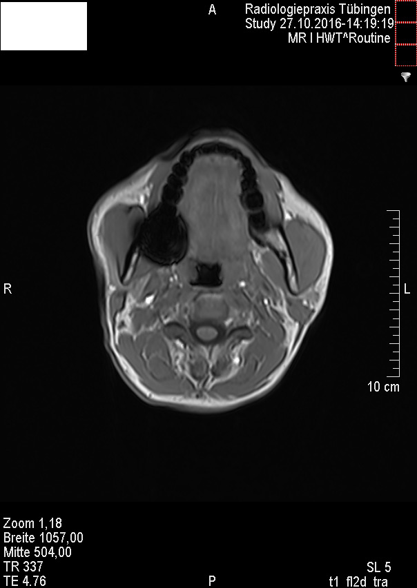 MRT Bild Auswertung Hals dunkler Fleck auf einer Seite? (Bilder) MRT Bild Auswertung Hals dunkler Fleck auf einer Seite? (Bilder)