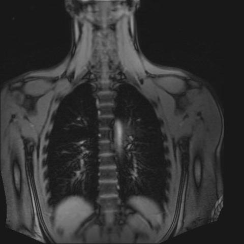 Mrt Bild Deuten Wirbelsaule Radiologie Mrt Bild Deuten Wirbelsaule Radiologie