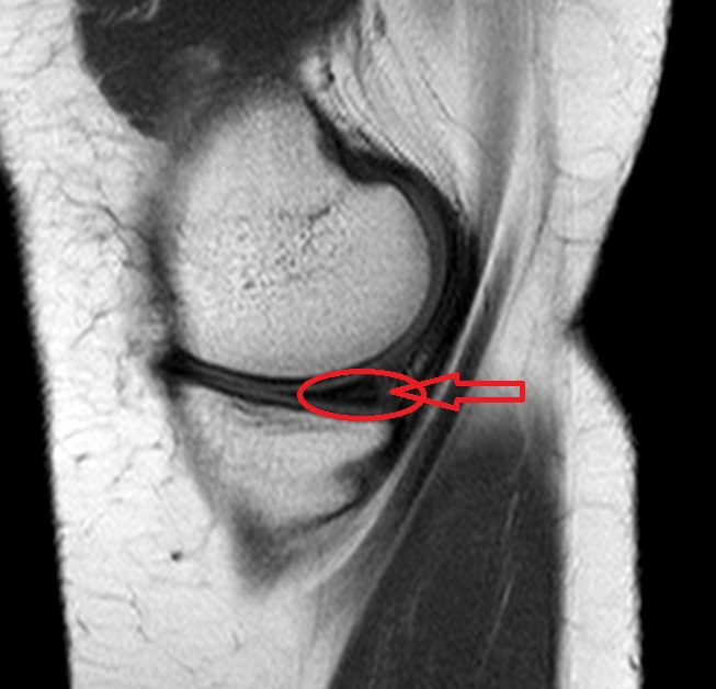 Mrt Bild Meniskus Riss Arzt Schmerzen Meniskusriss Mrt Bild Meniskus Riss Arzt Schmerzen Meniskusriss