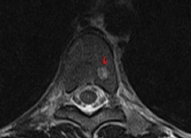 Wirbel - (Tumor, MRT, Radiologie)