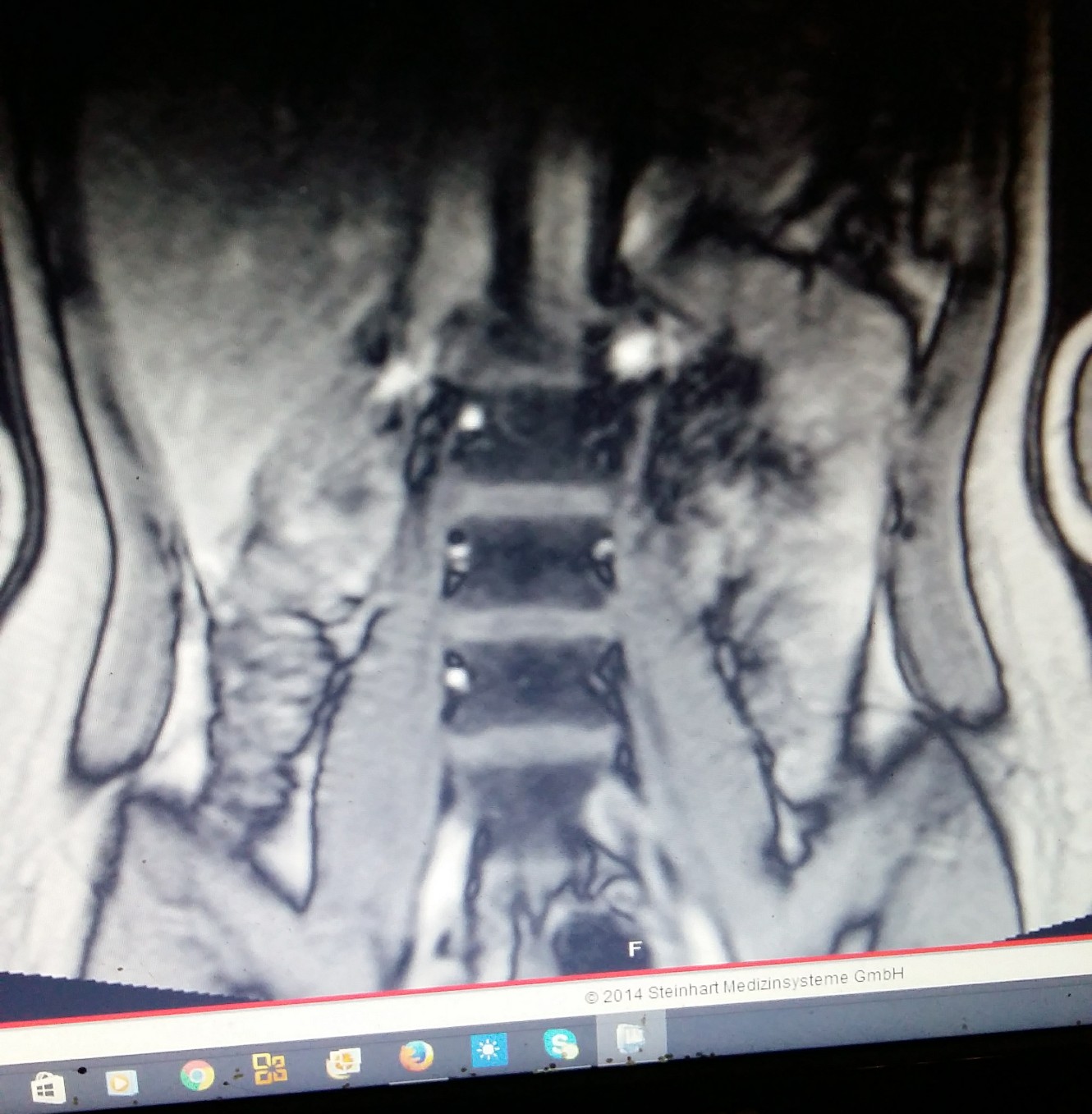 MRT Bilder Rücken (LWS) normal? (Schmerzen, Knie) MRT Bilder Rücken (LWS) normal? (Schmerzen, Knie)