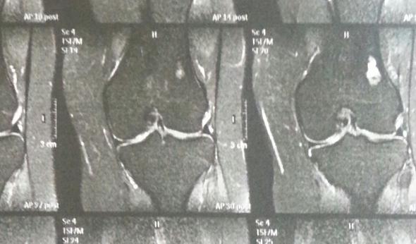 MRT Bild vom Linken Knie - (Arzt, Schmerzen, Knie)