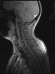 MRT der HWS Diagnose (Rückenschmerzen, Bandscheibenvorfall)