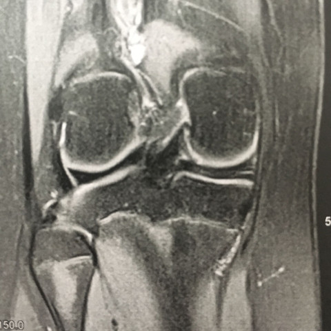 - (Schmerzen, Knie, rechts)