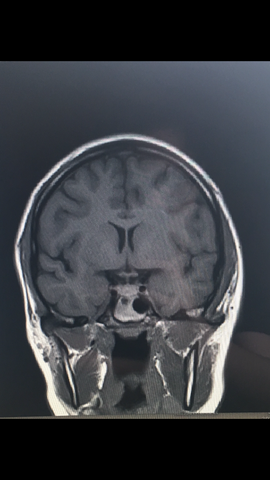 Mrt Gehirn Schwarzer Fleck Gesundheit Und Medizin Gesundheit Medizin