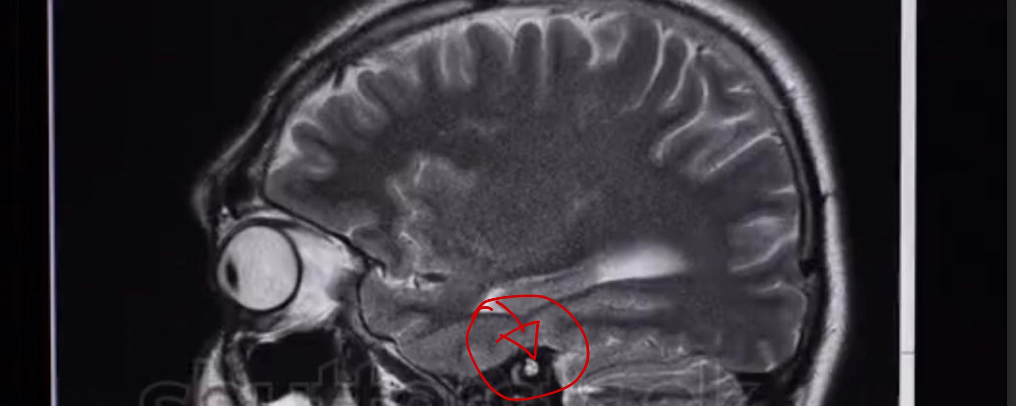 Mrt Gehirn Aufallig Gesundheit Und Medizin Medizin Mrt Befund