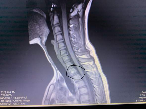 Mrt Komplett Wirbelsaule Radiologie Mrt Komplett Wirbelsaule Radiologie