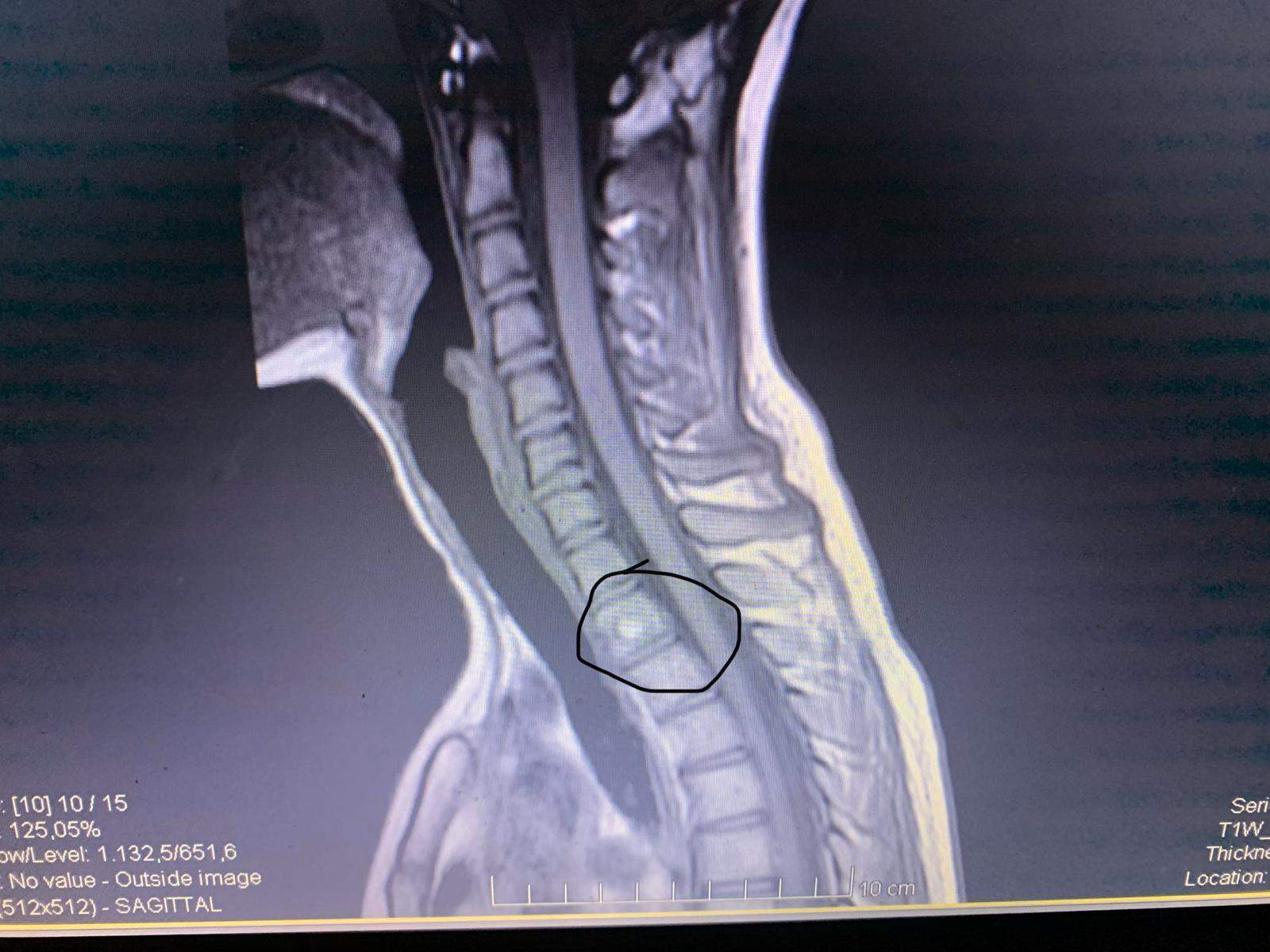 MRT Komplett Wirbelsäule? (Radiologie)