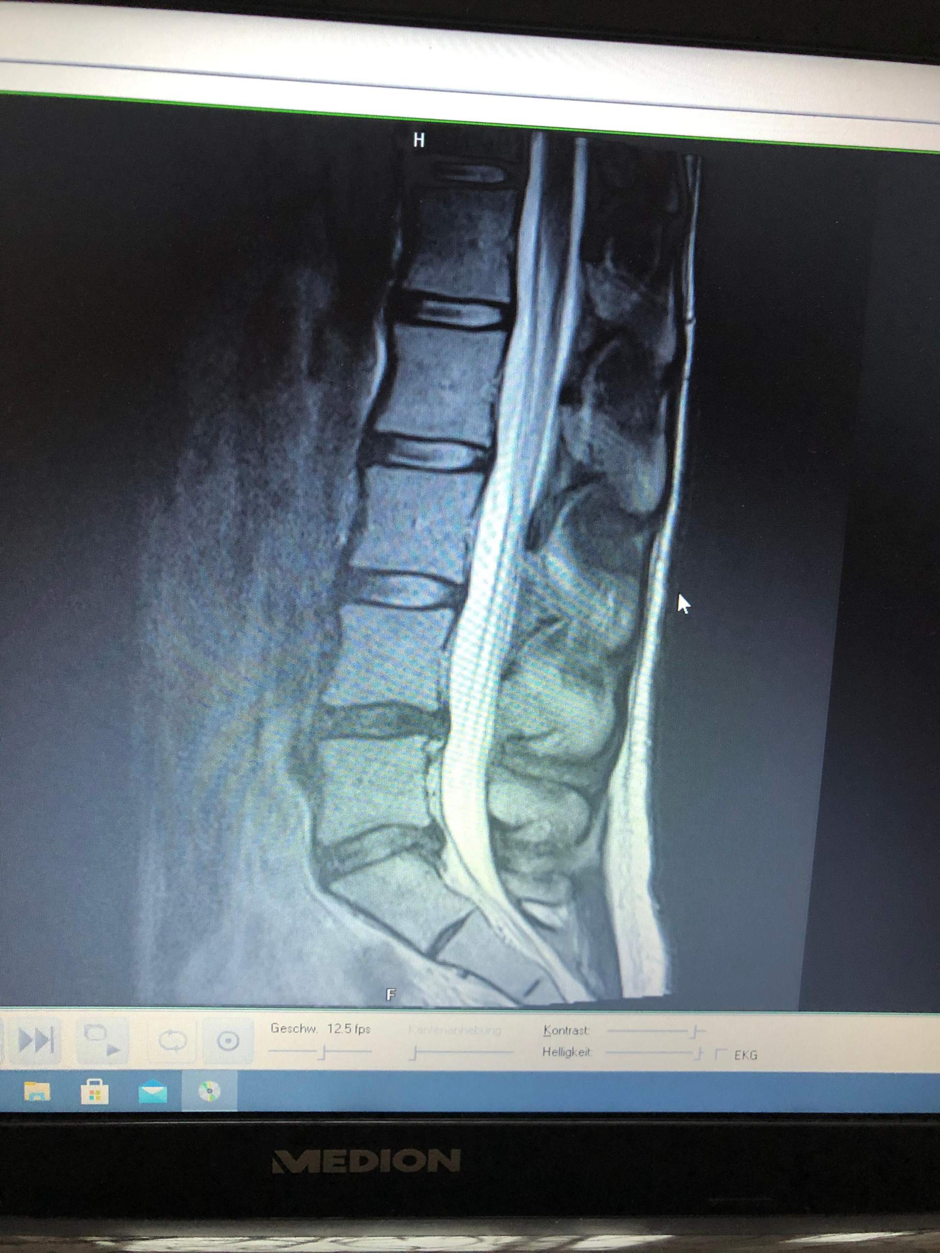 MRT LWS Bandscheibenvorfall? (Gesundheit und Medizin, Radiologie)